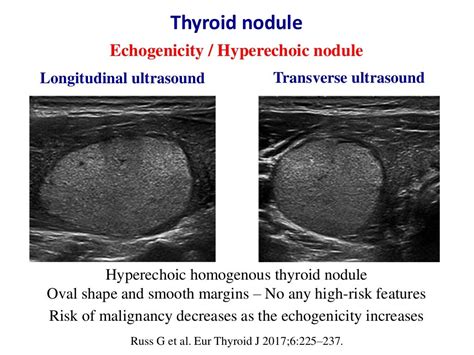 Thyroid cancer diagnosis has evolved to include computer-aided diagnosis (CAD) approaches to overcome the limitations of human ultrasound feature assessment. . Thyroid nodule ultrasound reddit